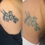 Remoção de Tatuagem em Sorocaba | Marília Giordano