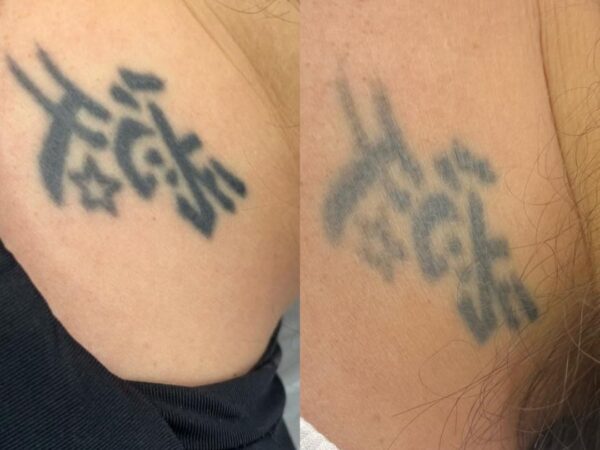 Remoção de Tatuagem em Sorocaba | Marília Giordano