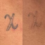 Remoção de Tatuagem em Sorocaba | Marília Giordano