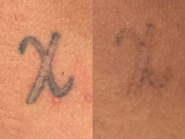 Remoção de Tatuagem em Sorocaba | Marília Giordano