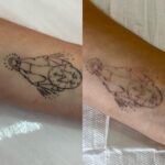 Remoção de Tatuagem em Sorocaba | Marília Giordano