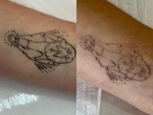 Remoção de Tatuagem em Sorocaba | Marília Giordano