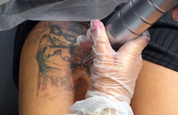 Principais Fatores que Influenciam na Remoção (Despigmentação)