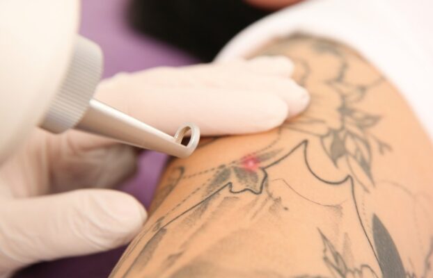 Remoção de Tatuagem em Sorocaba | Dra. Marília Giordano