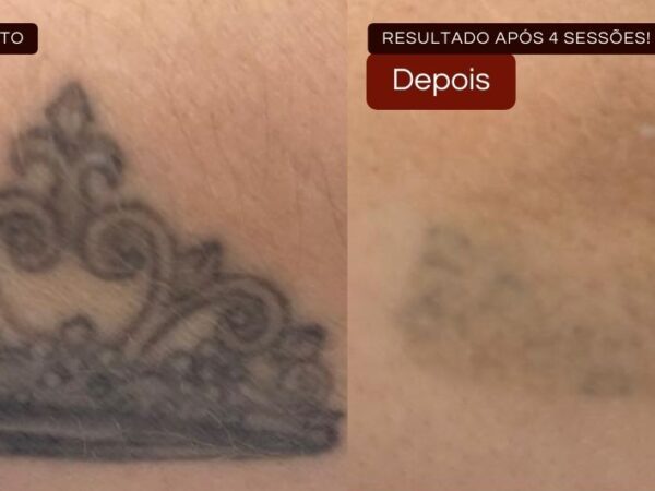 Remoção de Tatuagem em Sorocaba | Marília Giordano