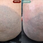 Remoção de Micropigmentação Capilar em Sorocaba | Marília Giordano