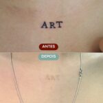 Remoção de Tatuagem em Sorocaba | Marília Giordano