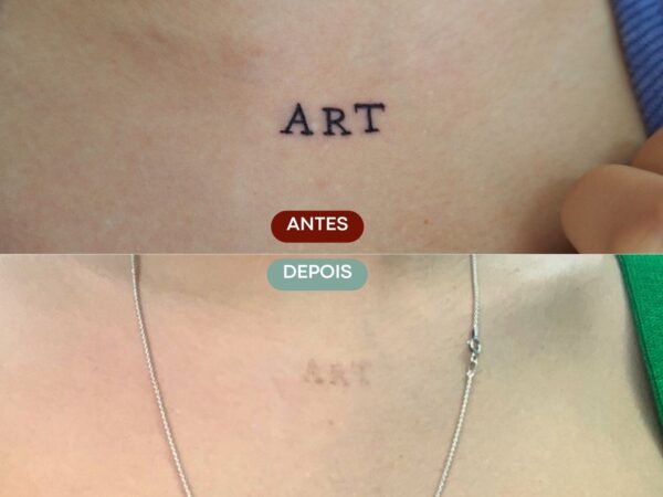 Remoção de Tatuagem em Sorocaba | Marília Giordano
