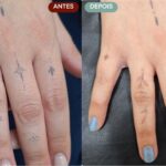 Remoção de Tatuagem em Sorocaba | Marília Giordano