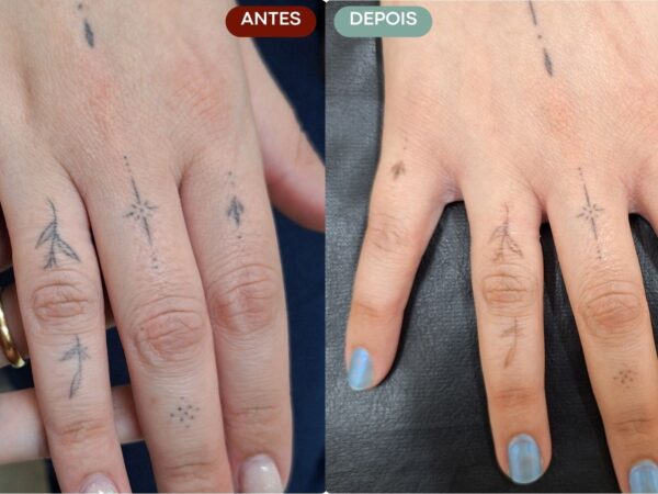 Remoção de Tatuagem em Sorocaba | Marília Giordano