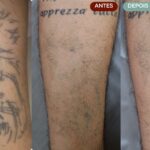 Remoção de Tatuagem em Sorocaba | Marília Giordano