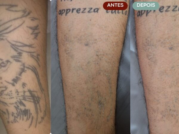 Remoção de Tatuagem em Sorocaba | Marília Giordano