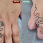 Remoção de Tatuagem em Sorocaba | Marília Giordano