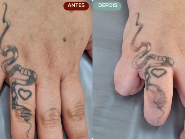 Remoção de Tatuagem em Sorocaba | Marília Giordano