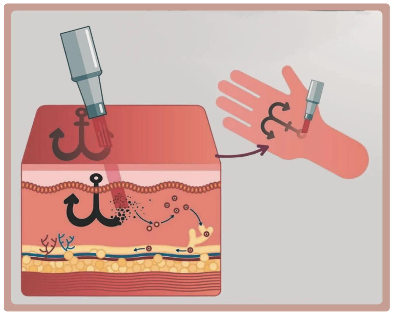 O que é e como funciona a despigmentação de tatuagem e micropigmentação